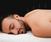 Acupuncture Therapy