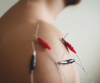 Acupuncture Therapy