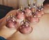 Hijama (Wet Cupping Therapy)