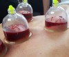 Hijama (Wet Cupping Therapy)