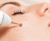 Wart Removal Therapy