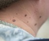 Wart Removal Therapy