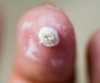Wart Removal Therapy