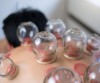 Wet, Dry & Fire Cupping Therapy