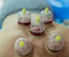 Wet, Dry & Fire Cupping Therapy