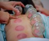 Wet, Dry & Fire Cupping Therapy