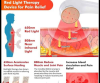 Laser Therapy