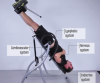 Inversion Table Therapy